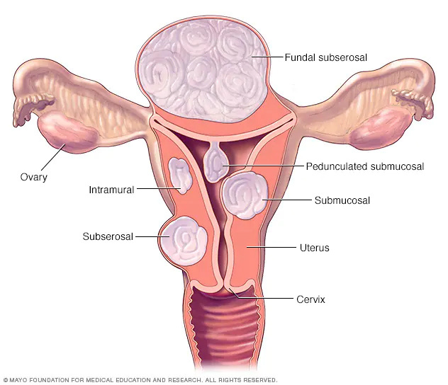 fibroid